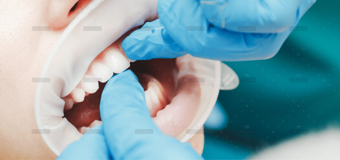 close up of female mouth with retractor doctor PWRQ6FA